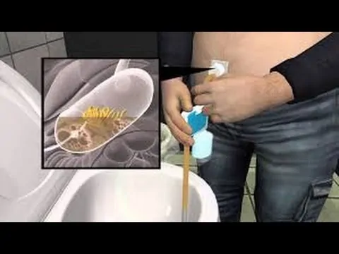 AspireAssist